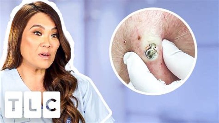 Dr Pimple Popper is back in 2022 popping 'corn kernels' on patients' heads |