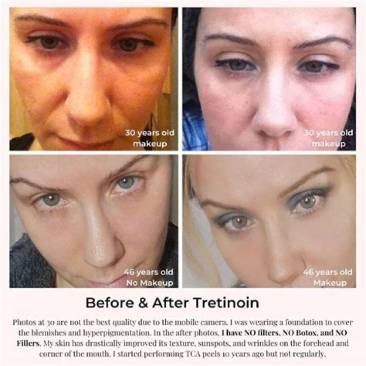 How long before you see results from Retin-A?