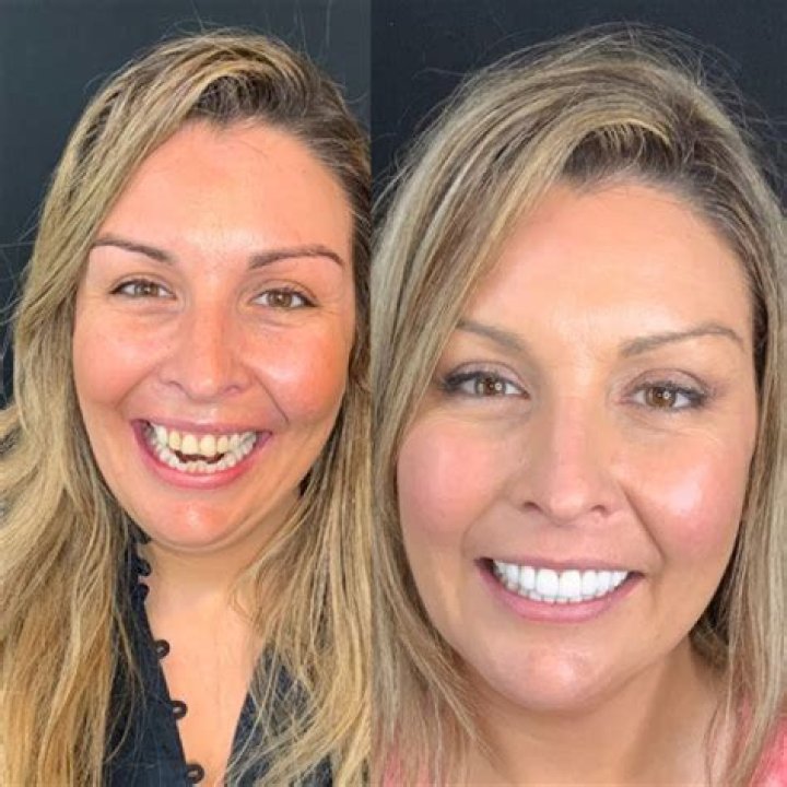 Matt Rife Teeth Before and After Veneers Photos Are Adorable correo